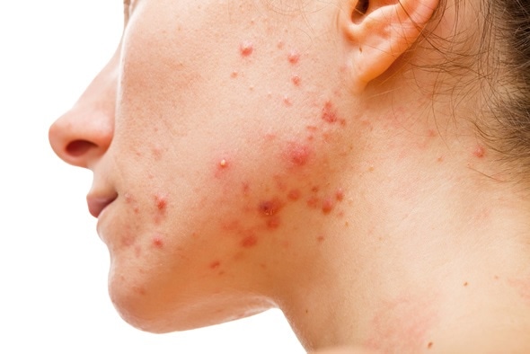 Acne - Image Copyright: Ocskay Bence / Shutterstock